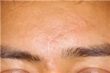 Chemical Peels, IPL, Fractional CO2 Laser Treatments After Photo by Landon Pryor, MD, FACS; Rockford, IL - Case 45043