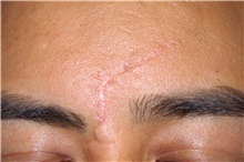 Chemical Peels, IPL, Fractional CO2 Laser Treatments Before Photo by Landon Pryor, MD, FACS; Rockford, IL - Case 45043