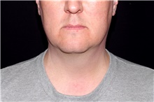 Liposuction Before Photo by Landon Pryor, MD, FACS; Rockford, IL - Case 45044