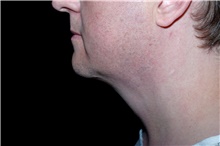 Liposuction After Photo by Landon Pryor, MD, FACS; Rockford, IL - Case 45044