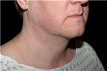 Liposuction After Photo by Landon Pryor, MD, FACS; Rockford, IL - Case 45044