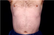 Liposuction After Photo by Landon Pryor, MD, FACS; Rockford, IL - Case 45045