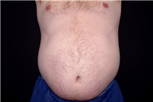 Liposuction Before Photo by Landon Pryor, MD, FACS; Rockford, IL - Case 45045
