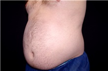 Liposuction Before Photo by Landon Pryor, MD, FACS; Rockford, IL - Case 45045