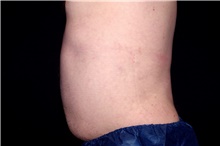Liposuction After Photo by Landon Pryor, MD, FACS; Rockford, IL - Case 45045