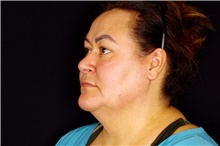 Facelift Before Photo by Landon Pryor, MD, FACS; Rockford, IL - Case 45046