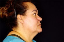 Facelift Before Photo by Landon Pryor, MD, FACS; Rockford, IL - Case 45046