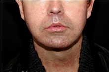 Lip Augmentation/Enhancement After Photo by Landon Pryor, MD, FACS; Rockford, IL - Case 45050
