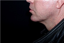 Lip Augmentation/Enhancement After Photo by Landon Pryor, MD, FACS; Rockford, IL - Case 45050