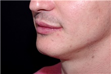 Lip Augmentation/Enhancement After Photo by Landon Pryor, MD, FACS; Rockford, IL - Case 45052