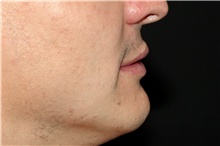 Lip Augmentation/Enhancement After Photo by Landon Pryor, MD, FACS; Rockford, IL - Case 45052