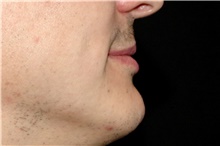 Lip Augmentation/Enhancement Before Photo by Landon Pryor, MD, FACS; Rockford, IL - Case 45052