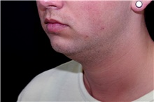 Liposuction Before Photo by Landon Pryor, MD, FACS; Rockford, IL - Case 45053