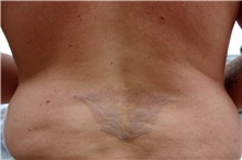 Tattoo Removal After Photo by Landon Pryor, MD, FACS; Rockford, IL - Case 45054