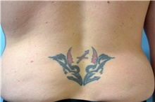 Tattoo Removal Before Photo by Landon Pryor, MD, FACS; Rockford, IL - Case 45054