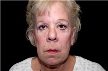 Facelift Before Photo by Landon Pryor, MD, FACS; Rockford, IL - Case 45056