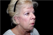 Facelift Before Photo by Landon Pryor, MD, FACS; Rockford, IL - Case 45056