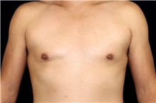 Male Breast Reduction After Photo by Landon Pryor, MD, FACS; Rockford, IL - Case 45058