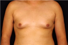 Male Breast Reduction Before Photo by Landon Pryor, MD, FACS; Rockford, IL - Case 45058
