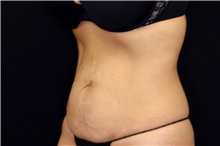 Tummy Tuck Before Photo by Landon Pryor, MD, FACS; Rockford, IL - Case 45062