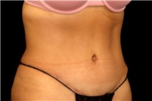 Tummy Tuck After Photo by Landon Pryor, MD, FACS; Rockford, IL - Case 45062