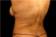 Liposuction After Photo by Landon Pryor, MD, FACS; Rockford, IL - Case 45063