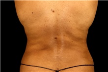 Liposuction After Photo by Landon Pryor, MD, FACS; Rockford, IL - Case 45063