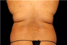 Liposuction Before Photo by Landon Pryor, MD, FACS; Rockford, IL - Case 45063