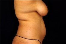 Liposuction Before Photo by Landon Pryor, MD, FACS; Rockford, IL - Case 45063