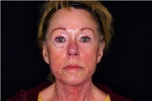 Brow Lift After Photo by Landon Pryor, MD, FACS; Rockford, IL - Case 45064
