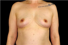 Breast Augmentation Before Photo by Landon Pryor, MD, FACS; Rockford, IL - Case 45066