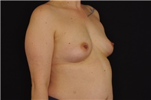 Breast Augmentation Before Photo by Landon Pryor, MD, FACS; Rockford, IL - Case 45066