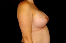 Breast Augmentation After Photo by Landon Pryor, MD, FACS; Rockford, IL - Case 45066