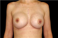 Breast Augmentation After Photo by Landon Pryor, MD, FACS; Rockford, IL - Case 45068