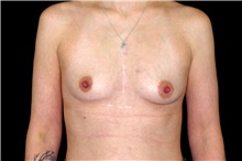 Breast Augmentation Before Photo by Landon Pryor, MD, FACS; Rockford, IL - Case 45068