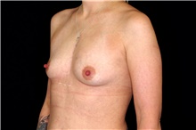 Breast Augmentation Before Photo by Landon Pryor, MD, FACS; Rockford, IL - Case 45068