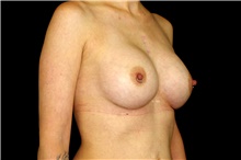 Breast Augmentation After Photo by Landon Pryor, MD, FACS; Rockford, IL - Case 45068