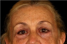 Brow Lift After Photo by Landon Pryor, MD, FACS; Rockford, IL - Case 45070