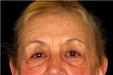 Brow Lift Before Photo by Landon Pryor, MD, FACS; Rockford, IL - Case 45070