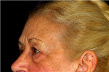 Brow Lift Before Photo by Landon Pryor, MD, FACS; Rockford, IL - Case 45070
