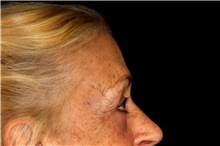 Brow Lift After Photo by Landon Pryor, MD, FACS; Rockford, IL - Case 45070