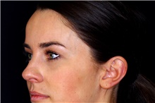 Ear Surgery Before Photo by Landon Pryor, MD, FACS; Rockford, IL - Case 45071