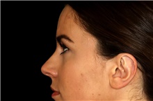 Ear Surgery After Photo by Landon Pryor, MD, FACS; Rockford, IL - Case 45071