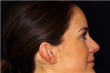 Ear Surgery Before Photo by Landon Pryor, MD, FACS; Rockford, IL - Case 45071