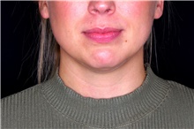 Liposuction Before Photo by Landon Pryor, MD, FACS; Rockford, IL - Case 45074