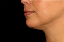 Liposuction After Photo by Landon Pryor, MD, FACS; Rockford, IL - Case 45074