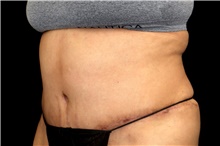 Tummy Tuck After Photo by Landon Pryor, MD, FACS; Rockford, IL - Case 45076