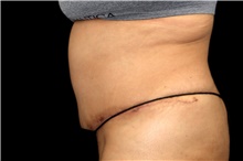 Tummy Tuck After Photo by Landon Pryor, MD, FACS; Rockford, IL - Case 45076