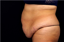 Tummy Tuck Before Photo by Landon Pryor, MD, FACS; Rockford, IL - Case 45076