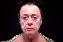 Facelift Before Photo by Landon Pryor, MD, FACS; Rockford, IL - Case 45077
